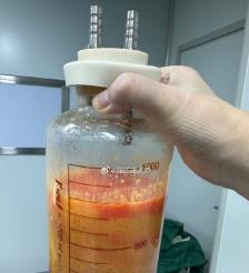 清徐水动力吸脂手术要做多久？